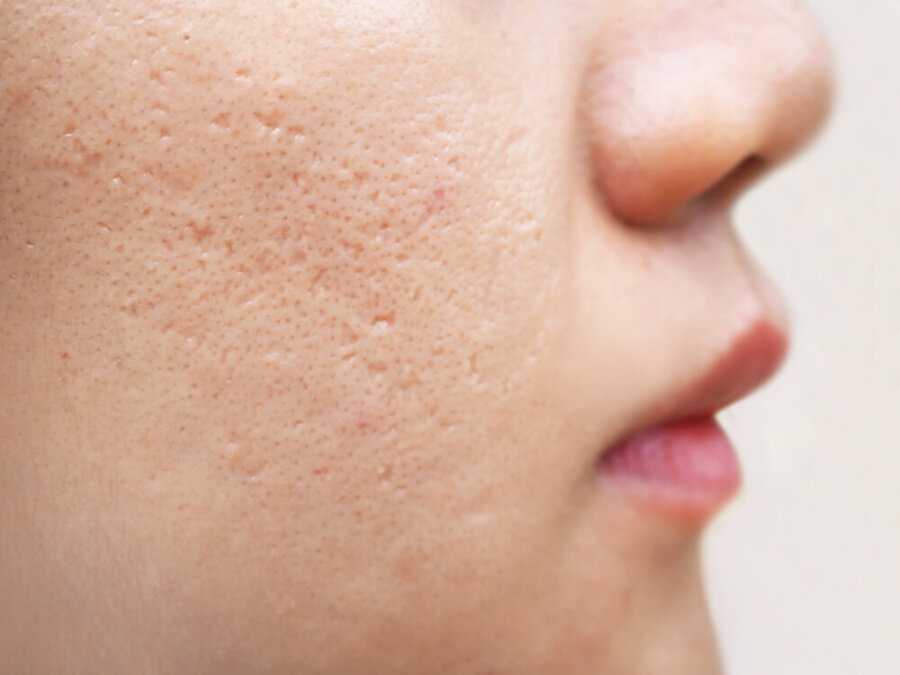 How to Treat Acne Scars