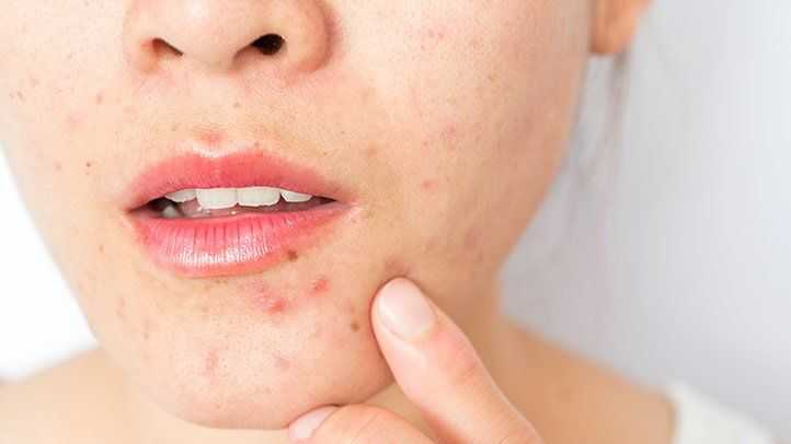 Understanding and Manage Active Acne