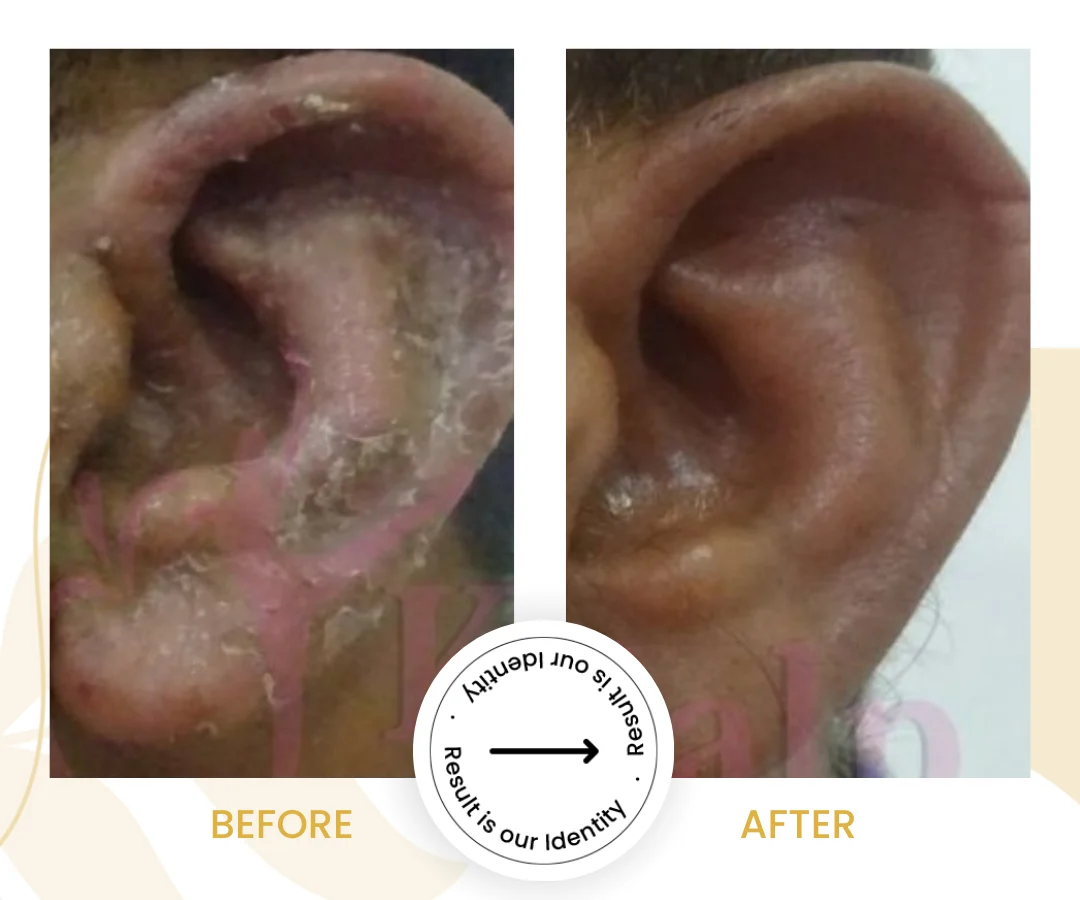 Fungal Infection (2)