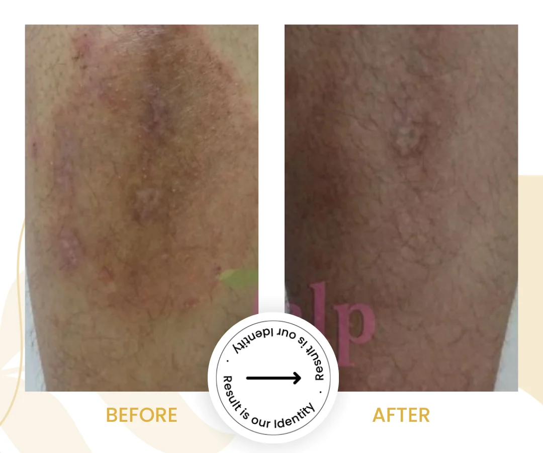 Fungal Infection (3)