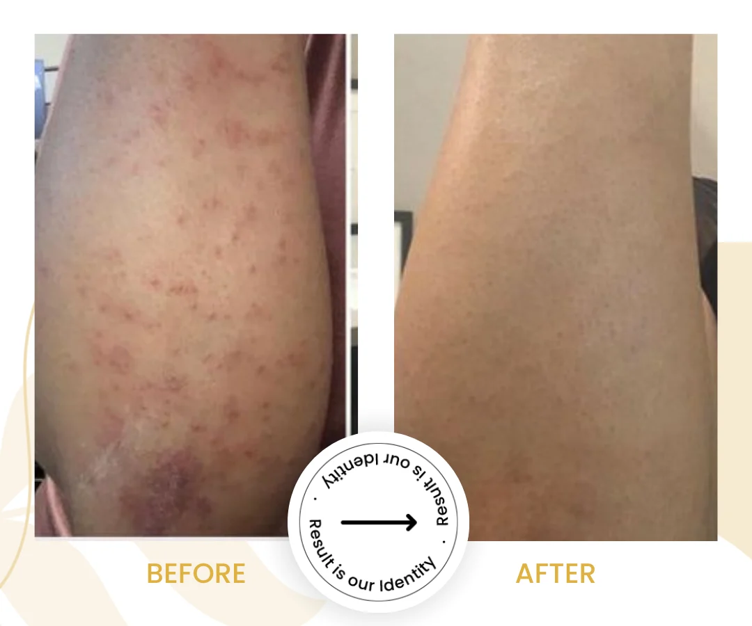 Viral Skin Infection1