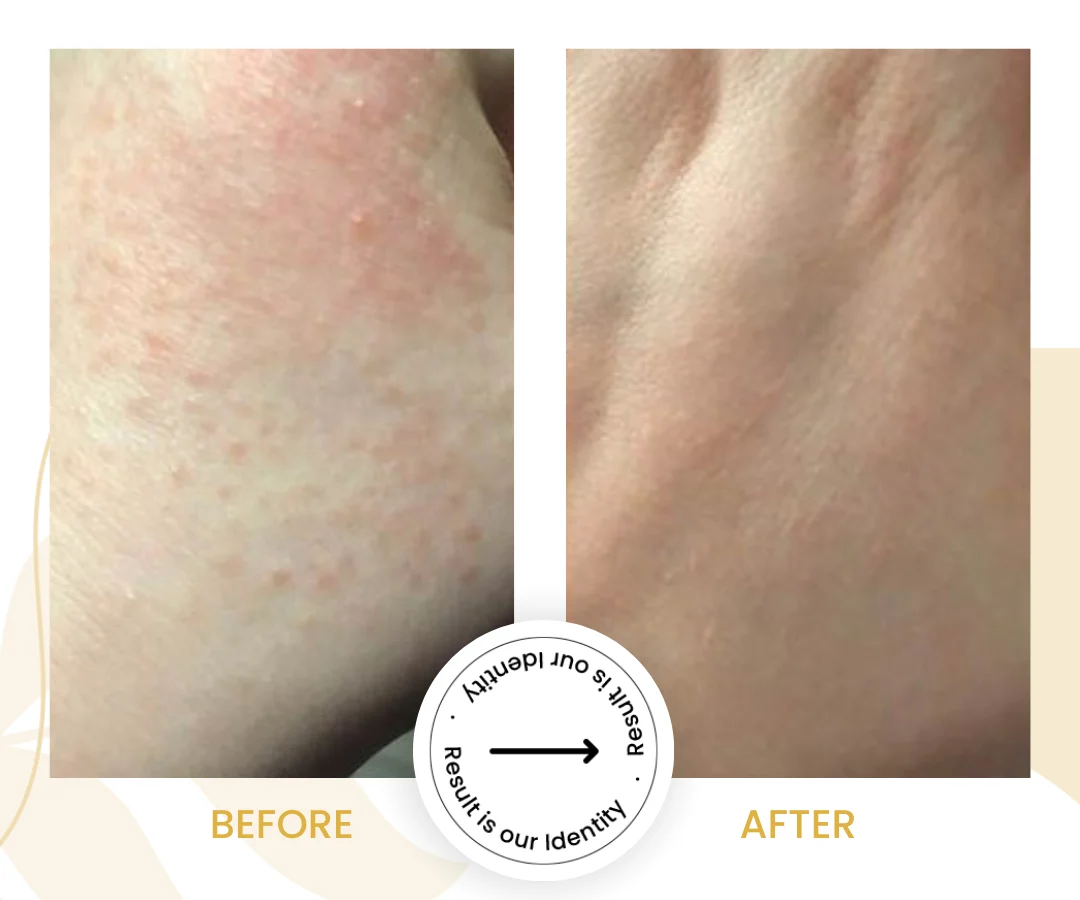 Viral Skin Infection2