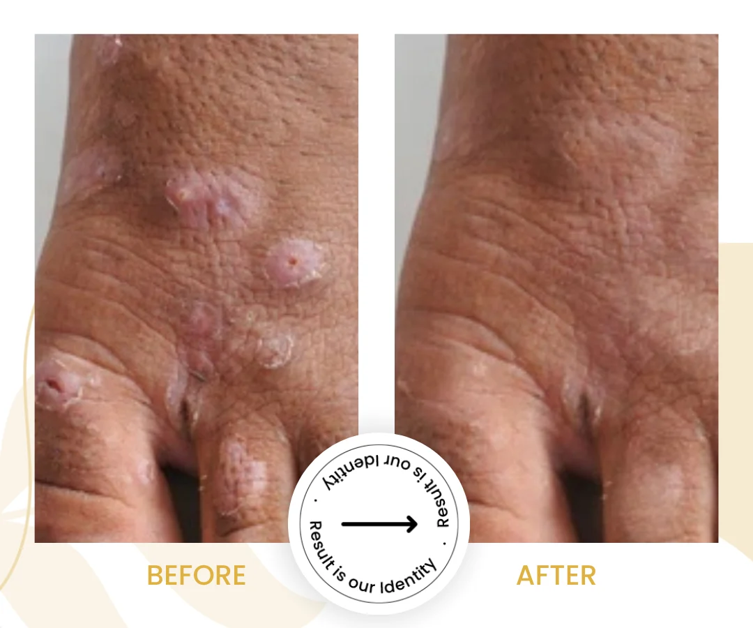 Viral Skin Infection3