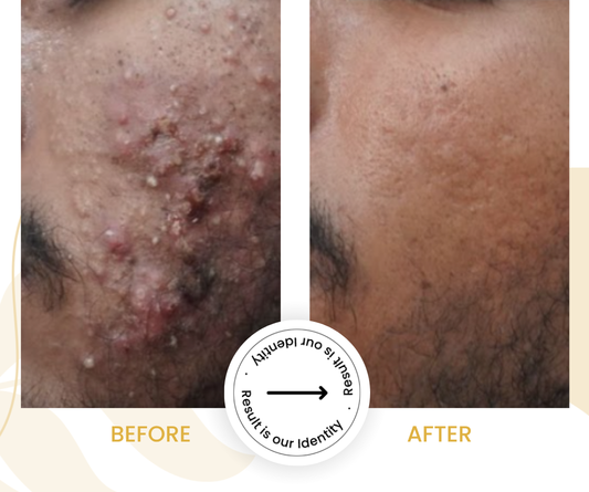 Clearer and smoother skin