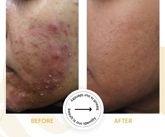 Reduced acne breakouts