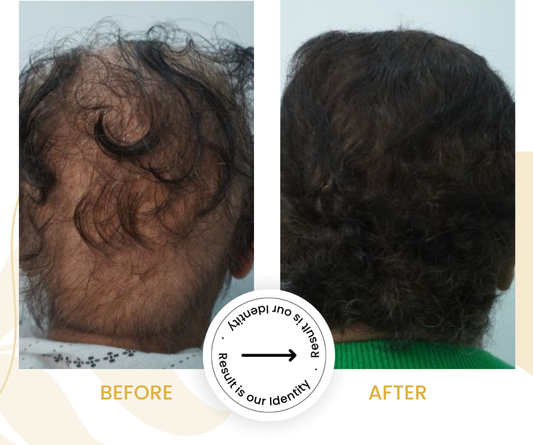 Reduced hair thinning