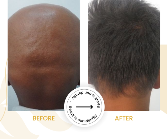 Improved hair density