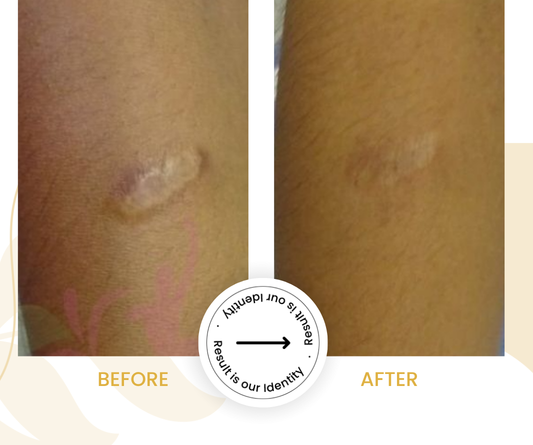 Reduced scar thickness