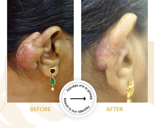 Improved scar texture