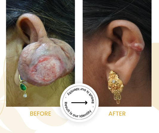 Less noticeable scar appearance