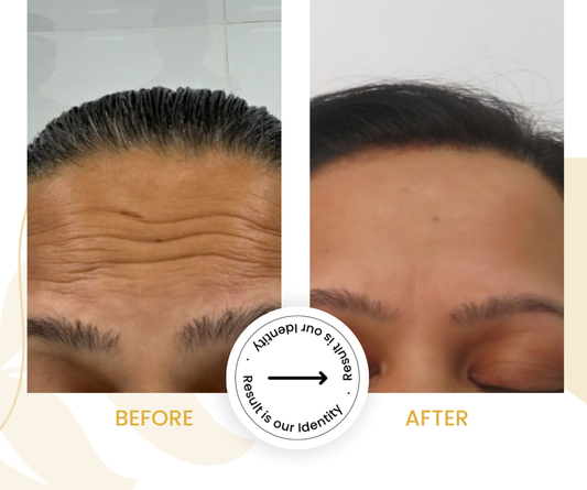 Reduced forehead lines