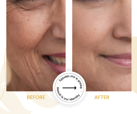 Softer crow’s feet