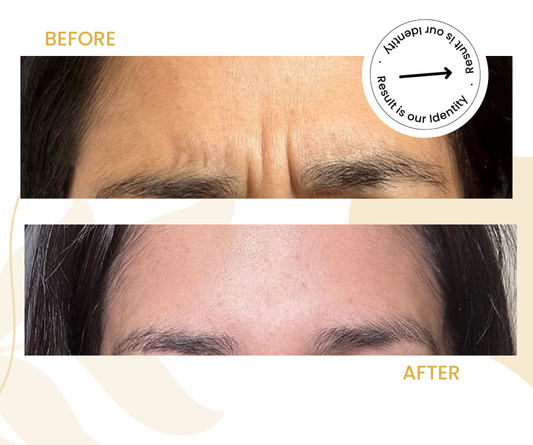 Improved facial smoothness