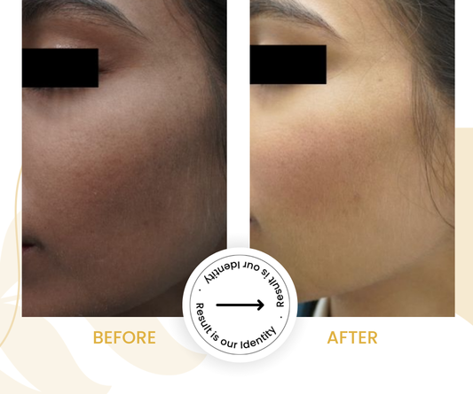 Smoother skin texture