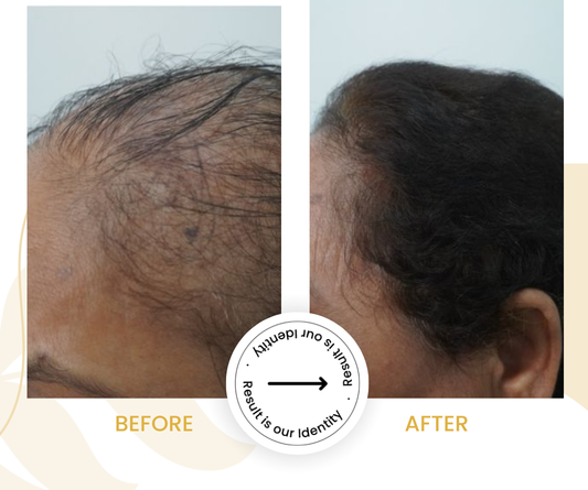 Improved hair density