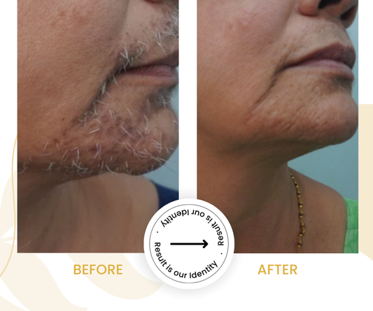 Reduced hair growth in treated areas