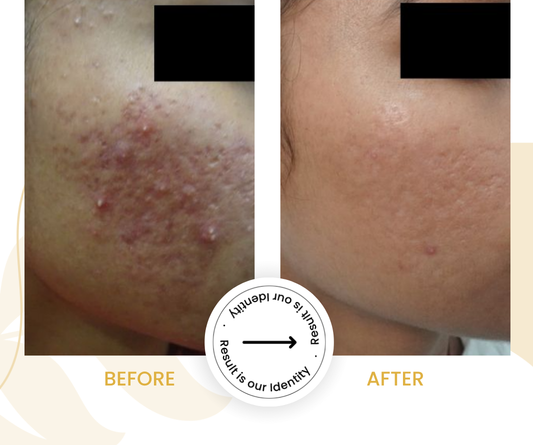 Smoother skin surface