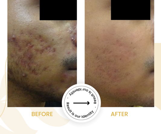 Improved skin texture