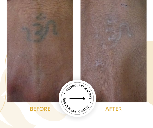 Faded tattoo pigments