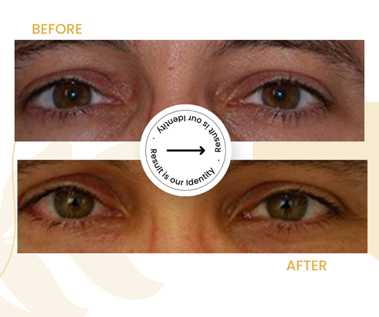 Fresher facial appearance