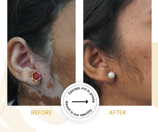 Improved skin tone balance