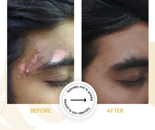 Reduced contrast of white patches