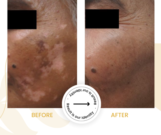 Repigmentation in affected areas